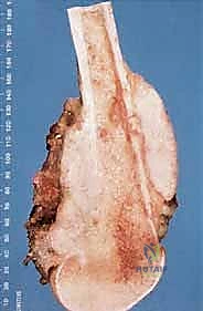 السديلات العضلية