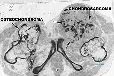 صورة طبية: دليل شامل لاستئصال الساركوما: فهم البيولوجيا، تحديد المراحل، ومبادئ الحفاظ على الأطراف مع الأستاذ الدكتور محمد هطيف