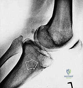 صورة توضيحية لـ دليل شامل لاستئصال الساركوما: فهم البيولوجيا، تحديد المراحل، ومبادئ الحفاظ على الأطراف مع الأستاذ الدكتور محمد هطيف