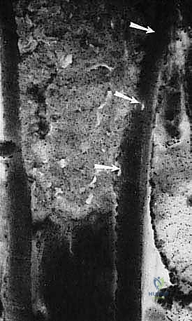 دليل شامل لاستئصال الساركوما: فهم البيولوجيا، تحديد المراحل، ومبادئ الحفاظ على الأطراف مع الأستاذ الدكتور محمد هطيف