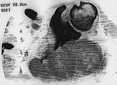 تحديد مراحل الورم