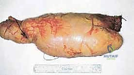 صورة توضيحية لـ دليل شامل لاستئصال الساركوما: فهم البيولوجيا، تحديد المراحل، ومبادئ الحفاظ على الأطراف مع الأستاذ الدكتور محمد هطيف