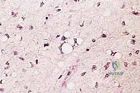 صورة توضيحية لـ دليل شامل لاستئصال الساركوما: فهم البيولوجيا، تحديد المراحل، ومبادئ الحفاظ على الأطراف مع الأستاذ الدكتور محمد هطيف