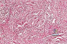 صورة طبية: دليل شامل لاستئصال الساركوما: فهم البيولوجيا، تحديد المراحل، ومبادئ الحفاظ على الأطراف مع الأستاذ الدكتور محمد هطيف