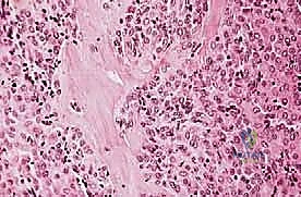 صورة توضيحية لـ دليل شامل لاستئصال الساركوما: فهم البيولوجيا، تحديد المراحل، ومبادئ الحفاظ على الأطراف مع الأستاذ الدكتور محمد هطيف