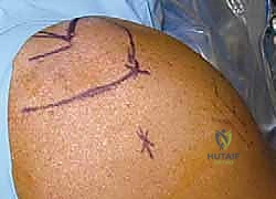 صورة طبية: منظار الكتف: دليلك الشامل لفهم الإجراء والتعافي مع الأستاذ الدكتور محمد هطيف