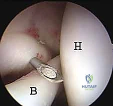 صورة طبية: منظار الكتف: دليلك الشامل لفهم الإجراء والتعافي مع الأستاذ الدكتور محمد هطيف