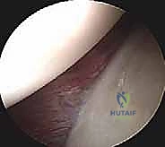 صورة توضيحية لـ منظار الكتف: دليلك الشامل لفهم الإجراء والتعافي مع الأستاذ الدكتور محمد هطيف