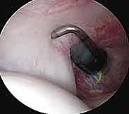 صورة توضيحية لـ منظار الكتف: دليلك الشامل لفهم الإجراء والتعافي مع الأستاذ الدكتور محمد هطيف