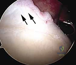 Illustration of shoulder arthroscopy the basics - Dr. Mohammed Hutaif