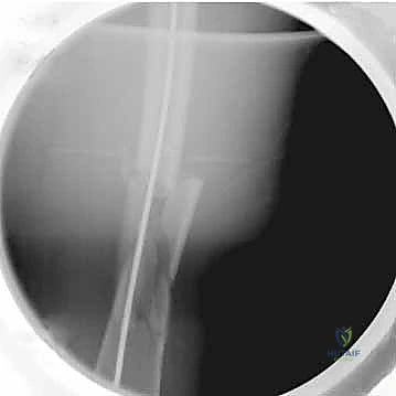 صورة توضيحية لـ تثبيت كسر عظم الفخذ بالمسمار النخاعي الأمامي: دليل شامل لمرضى صنعاء