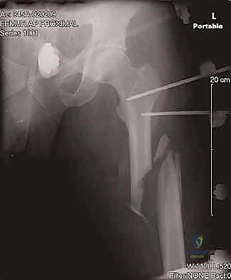صورة توضيحية لـ تثبيت كسر عظم الفخذ بالمسمار النخاعي الأمامي: دليل شامل لمرضى صنعاء