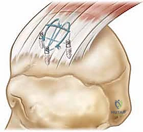 إصلاح الكفة المدورة بالمنظار مزدوج الصفوف: استعادة قوة الكتف بلا ألم مع الأستاذ الدكتور محمد هطيف