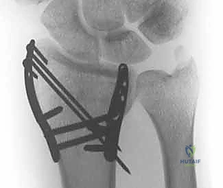 Illustration of carpal facet horizon - Dr. Mohammed Hutaif