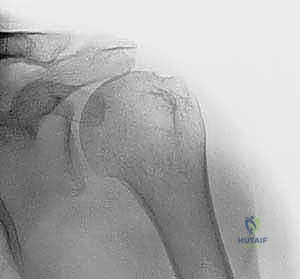 تغذية العضلة الظهرية العريضة - الحزمة العصبية الوعائية