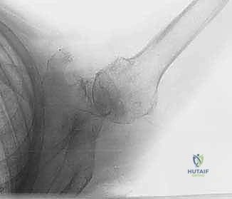 صورة طبية: نقل وتر العضلة الظهرية العريضة: حل متقدم لتمزقات الكفة المدورة غير القابلة للإصلاح في الكتف مع الأستاذ الدكتور محمد هطيف