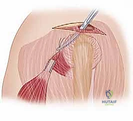 صورة توضيحية لـ نقل وتر العضلة الظهرية العريضة: حل متقدم لتمزقات الكفة المدورة غير القابلة للإصلاح في الكتف مع الأستاذ الدكتور محمد هطيف