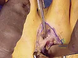 Illustration of less than degrees - Dr. Mohammed Hutaif