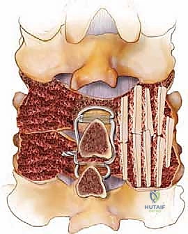 الأسباب المرضية ودواعي اللجوء لعملية الدمج الخلفي للفقرات