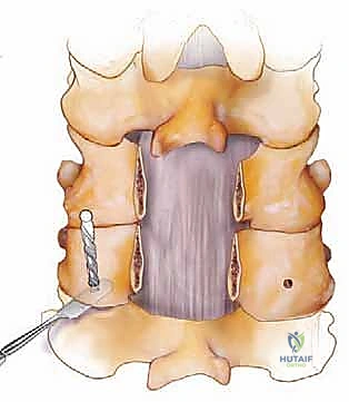إدخال البراغي وتثبيت الفقرات العنقية باستخدام التيتانيوم