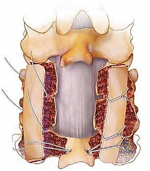 زراعة الطعوم العظمية لتحفيز اندماج الفقرات
