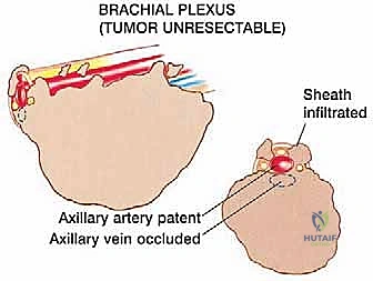 تقييم الألم وتحدد الحركة لدى مريض أورام