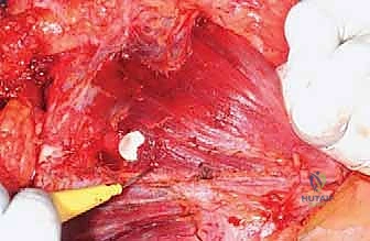 الأستاذ الدكتور محمد هطيف أثناء التحضير لجراحة دقيقة