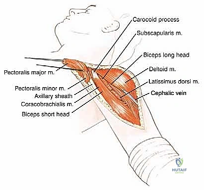 صورة طبية: استئصال العضد الداني وإعادة البناء بالطرف الاصطناعي: دليل شامل لمرضى أورام الكتف مع الأستاذ الدكتور محمد هطيف في صنعاء