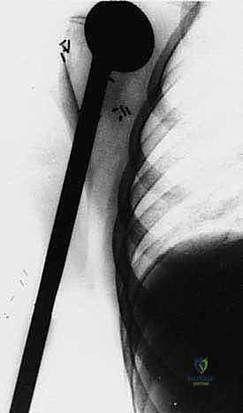 صورة توضيحية لـ استئصال العضد الداني وإعادة البناء بالطرف الاصطناعي: دليل شامل لمرضى أورام الكتف مع الأستاذ الدكتور محمد هطيف في صنعاء