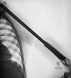 صورة طبية: استئصال العضد الداني وإعادة البناء بالطرف الاصطناعي: دليل شامل لمرضى أورام الكتف مع الأستاذ الدكتور محمد هطيف في صنعاء