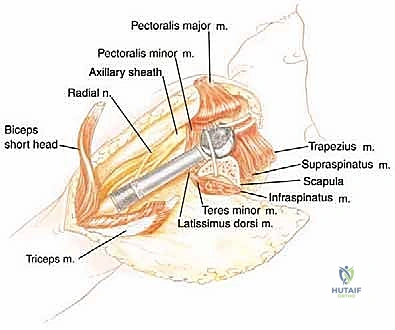 صورة توضيحية لـ استئصال العضد الداني وإعادة البناء بالطرف الاصطناعي: دليل شامل لمرضى أورام الكتف مع الأستاذ الدكتور محمد هطيف في صنعاء