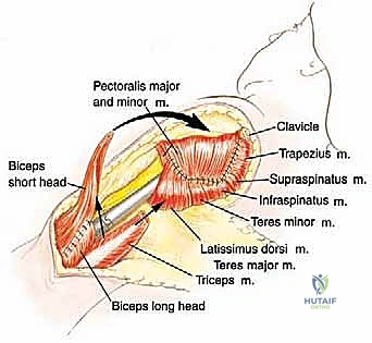 استئصال العضد الداني وإعادة البناء بالطرف الاصطناعي: دليل شامل لمرضى أورام الكتف مع الأستاذ الدكتور محمد هطيف في صنعاء