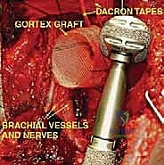 صورة طبية: استئصال العضد الداني وإعادة البناء بالطرف الاصطناعي: دليل شامل لمرضى أورام الكتف مع الأستاذ الدكتور محمد هطيف في صنعاء