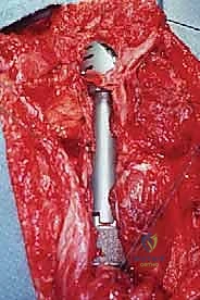 صورة توضيحية لـ استئصال العضد الداني وإعادة البناء بالطرف الاصطناعي: دليل شامل لمرضى أورام الكتف مع الأستاذ الدكتور محمد هطيف في صنعاء