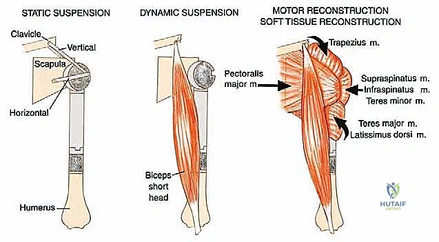 صورة توضيحية لـ استئصال العضد الداني وإعادة البناء بالطرف الاصطناعي: دليل شامل لمرضى أورام الكتف مع الأستاذ الدكتور محمد هطيف في صنعاء