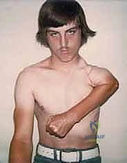 صورة توضيحية لـ استئصال العضد الداني وإعادة البناء بالطرف الاصطناعي: دليل شامل لمرضى أورام الكتف مع الأستاذ الدكتور محمد هطيف في صنعاء