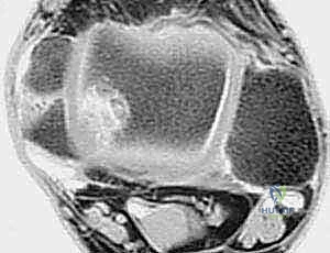 صورة توضيحية لـ إعادة بناء رباط الكاحل الجانبي المزمن بالطعوم الذاتية: خبرة الأستاذ الدكتور محمد هطيف في صنعاء