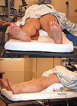 أسباب تمزق أربطة الكاحل المتكررة