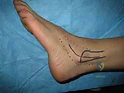 استخراج وتر الرشيق كطعم ذاتي