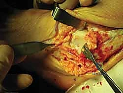 تجهيز الأنفاق العظمية في الشظية والكاحل