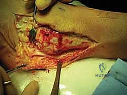 إعادة بناء رباط الكاحل الجانبي المزمن بالطعوم الذاتية: خبرة الأستاذ الدكتور محمد هطيف في صنعاء