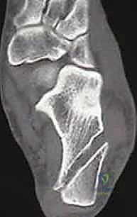 تمرير الطعم الذاتي لإعادة بناء الرباط