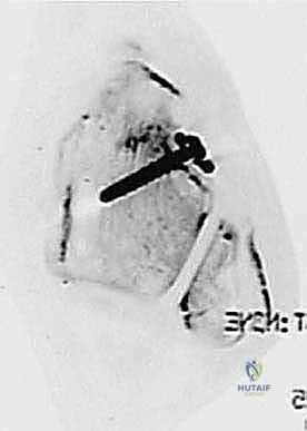 صورة توضيحية لـ إعادة بناء رباط الكاحل الجانبي المزمن بالطعوم الذاتية: خبرة الأستاذ الدكتور محمد هطيف في صنعاء