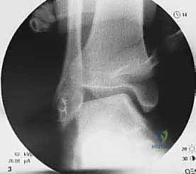 صورة توضيحية لـ إعادة بناء أربطة الكاحل الجانبية بالطعوم: حل نهائي لعدم الاستقرار المزمن