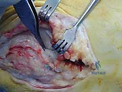 تطبيق العلاج التحفظي والدعامات للكاحل