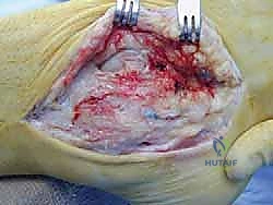 تشخيص الألم المزمن في الجزء الخارجي للكاحل