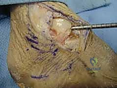 مقارنة بين الأربطة السليمة والممزقة جراحياً