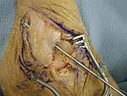 تجهيز المريض والتخدير قبل جراحة الكاحل
