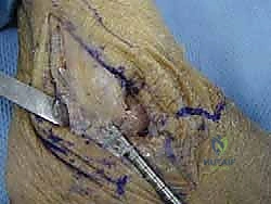 إغلاق الجرح ووضع الجبيرة الواقية للكاحل