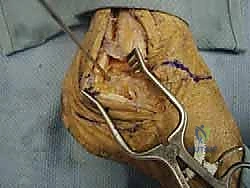 صورة توضيحية لـ إعادة بناء أربطة الكاحل الجانبية بالطعوم: حل نهائي لعدم الاستقرار المزمن مع الأستاذ الدكتور محمد هطيف